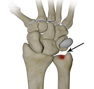 ulnar carpal impaction test|treatment for ulnar impaction syndrome.